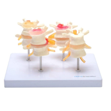 Модель міжхребцевих дисків із захворюваннями