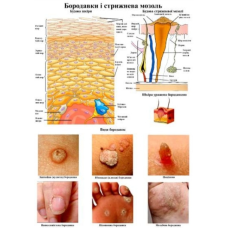 Плакат Бородавки і стрижнева мозоль розмір Плакат для подолога А2