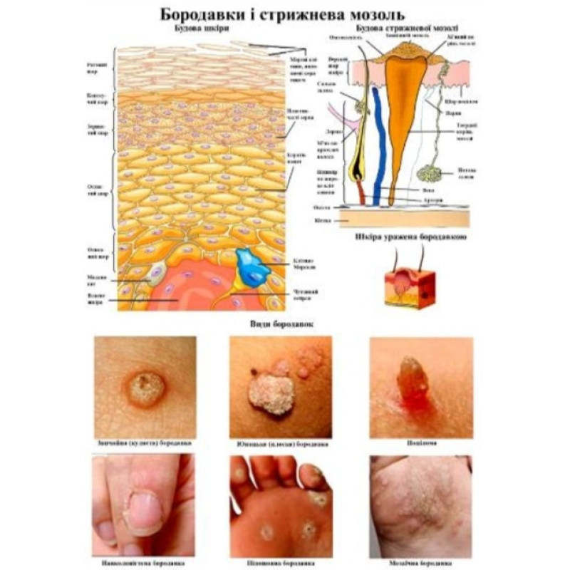Плакат Бородавки і стрижнева мозоль розмір Плакат для подолога А2
