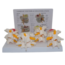 Модель міжхребцевих дисків із захворюваннями