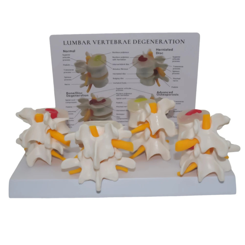 Модель міжхребцевих дисків із захворюваннями Модель міжхребцевих дисків із захворюваннями