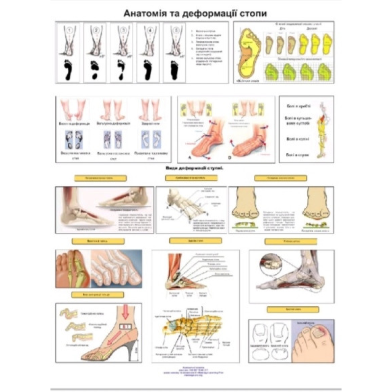 Плакат Анатомія та деформація стопи 86×67см Демонстраційний матеріал для пацієнтів Плакат стопи