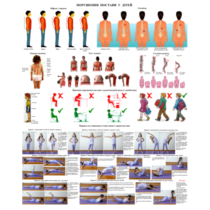 Плакат Порушення постави людини 86×67см Навчальний плакат Демонстраційний плакат порушення постави дітей