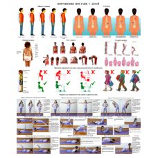 Плакат Порушення постави людини 50×64.5см.