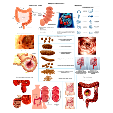 Анатомічний плак Хвороби кишківника 67х86 см Плакат із хворобами кишківника людини