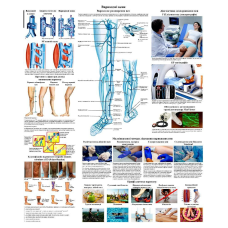 Плакат Варикозні вени 50 х 64,5 см Демонстраційний матеріал для медичного кабінету